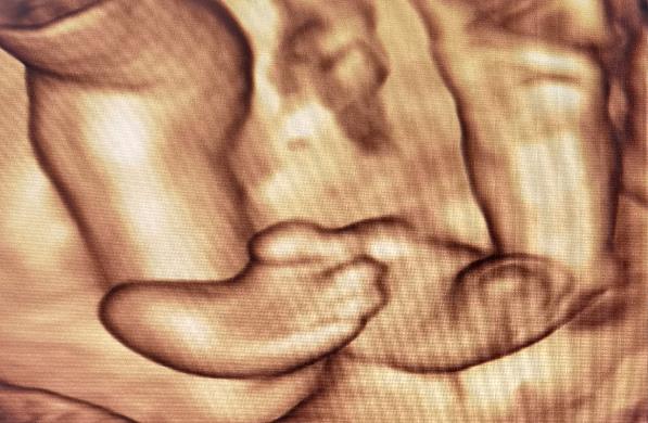 孕30周，四维彩超检查出胎儿双足内翻