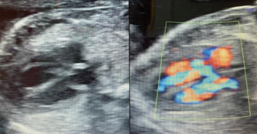 四维超声检查发现一例胎儿先天性心脏病