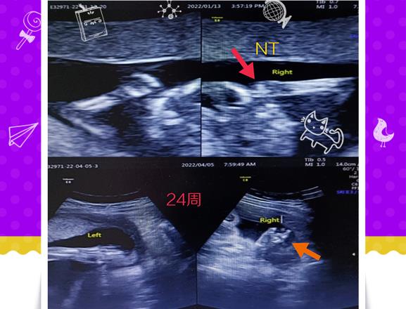 产前检查发现一例胎儿手指发育异常