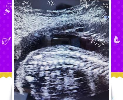 金普妇产医院产前筛查发现胎儿闭合性脊柱裂一例
